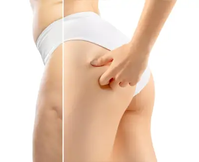 Гладкая кожа без целлюлита: курс восстановления текстуры и плотности